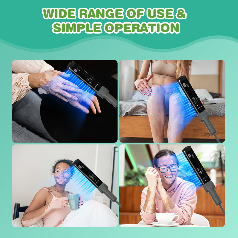 UVB lampa Kernel KN-4003BL 311nm na lupénku a vitiligo