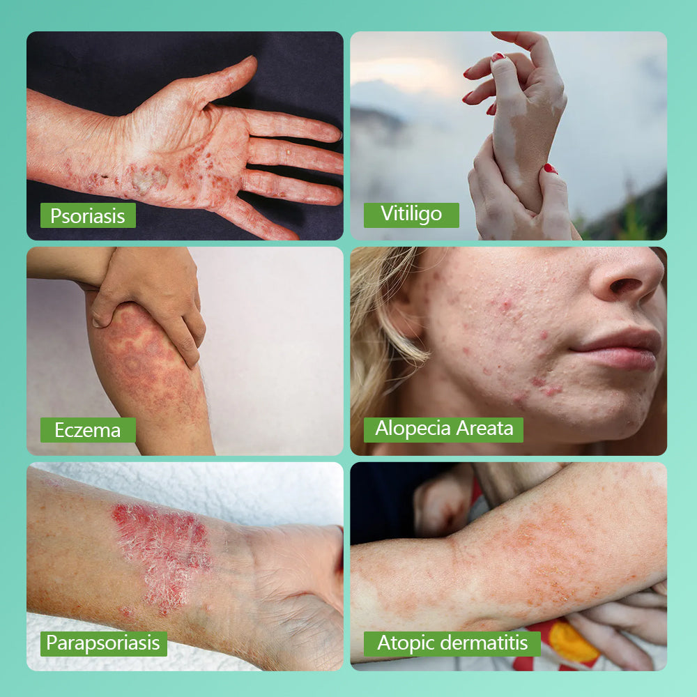 KN-4003BL 311nm UVB-Handlampe gegen Psoriasis und Vitiligo