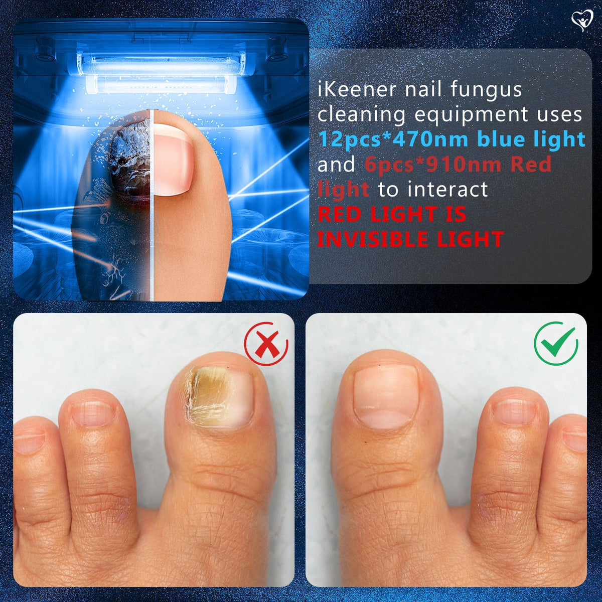 Dispositivo per la fototerapia contro la micosi delle unghie dei piedi — Trattamento di più unghie
