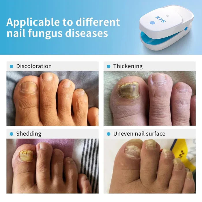 NovaPulse Dual-Wavelength Nail Fungus Laser Devices Starter Kit