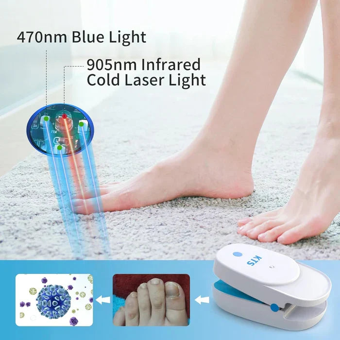 Sistema de terapia láser para los hongos de las uñas LuminNail — 905 nm y 470 nm