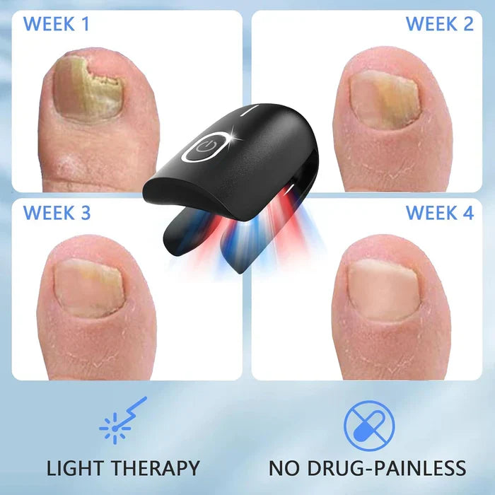 Laserbehandlingsapparat mot neglesopp for behandling av onykomykose