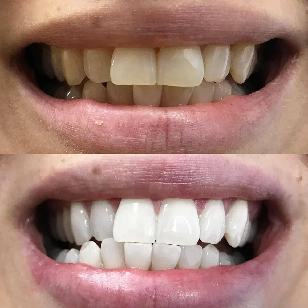 Color-Correcting Teeth Whitening Pen — Daily Brightening Care