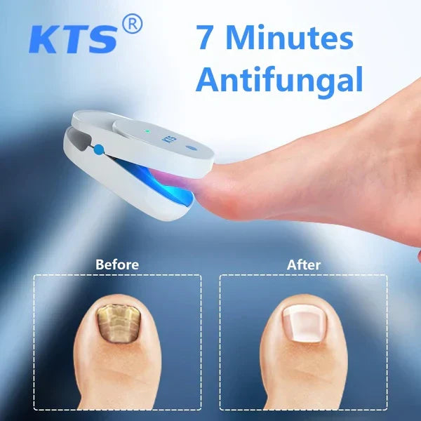Sistema de terapia láser para los hongos de las uñas LuminNail — 905 nm y 470 nm