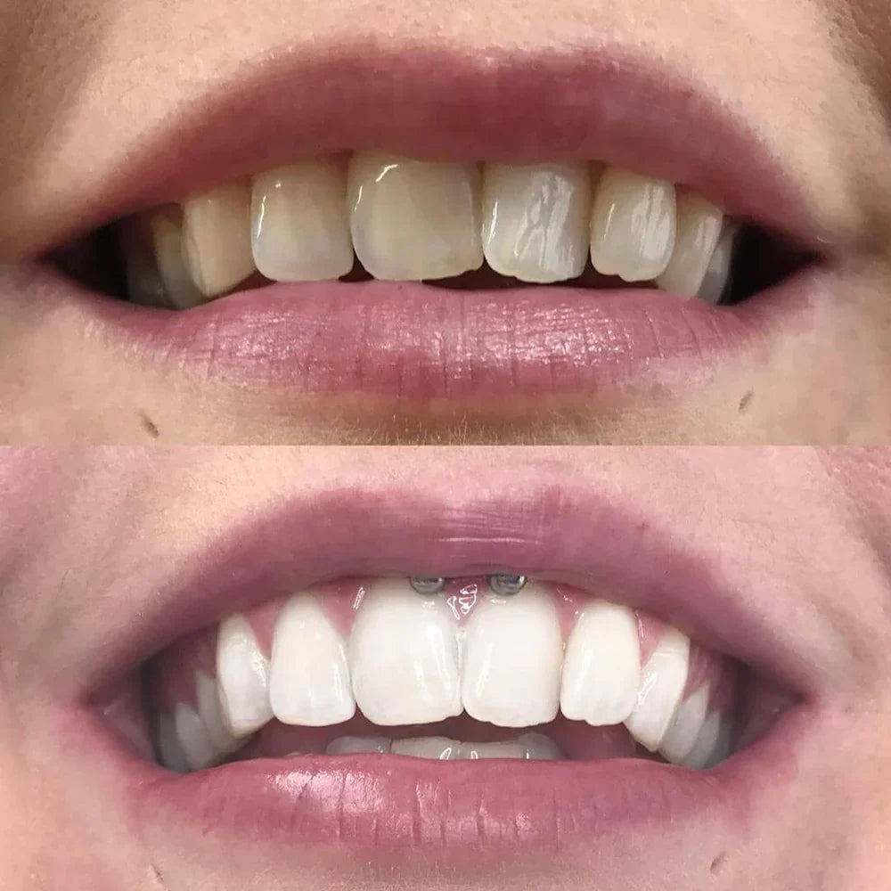 Diamond Smile 钻石亮白牙笔 - 10分钟绽放亮白笑容