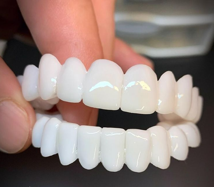 Lente per sorriso Norvo White regolabile — Protesi flessibile per una correzione estetica immediata