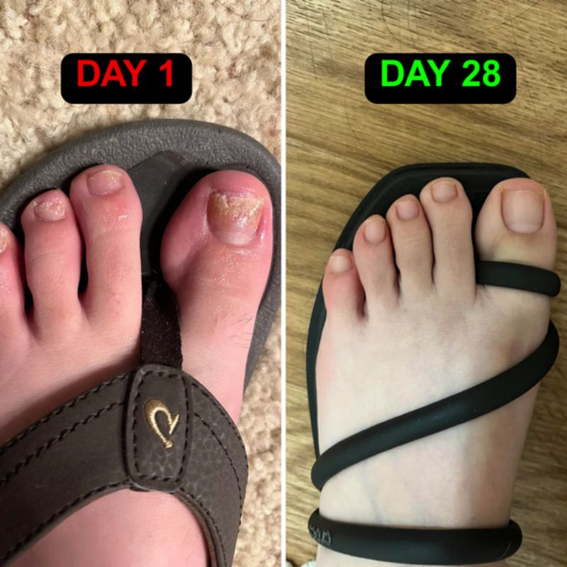 Blue & Near-Infrared Nail Light Therapy Device for Onychomycosis