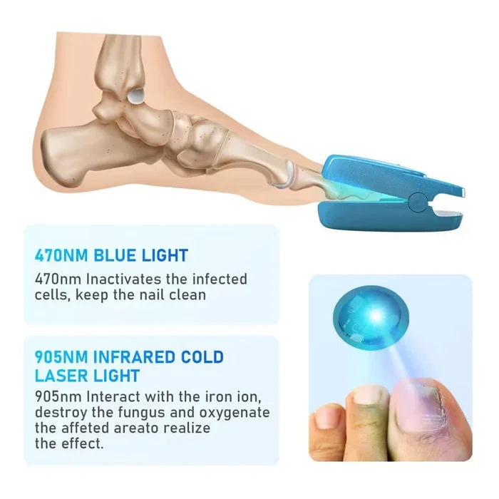 Ny laser for behandling av onykomykose — 905nm/470nm med to bølgelengder