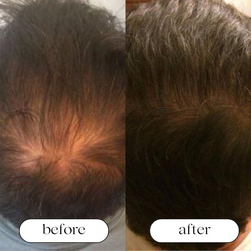 Hair Growth Red Light Therapy Cap — Scalp Care, Fuller Hair