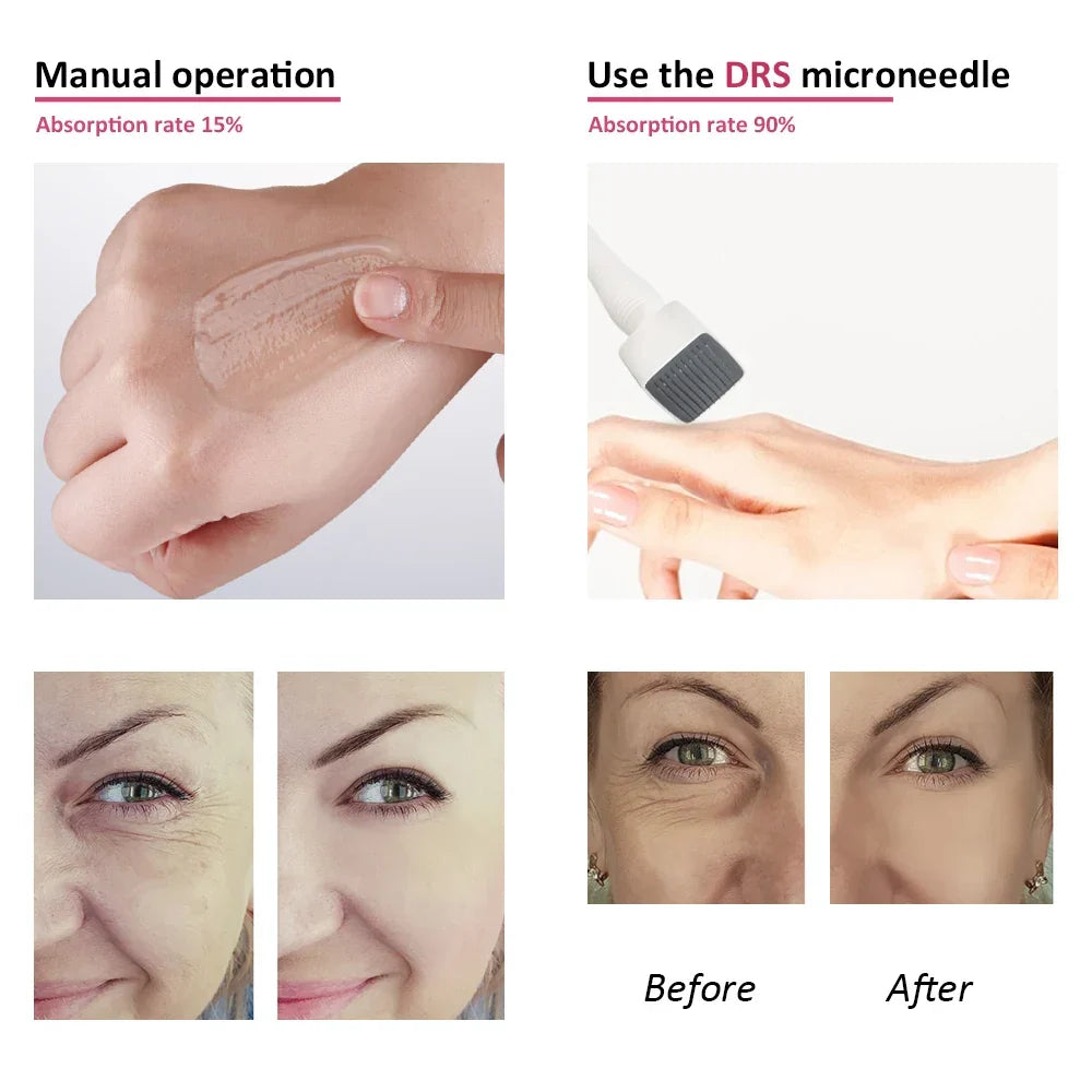 Ρυθμιζόμενο Derma Roller Stamp μικροβελονισμού 140 NovaDerm