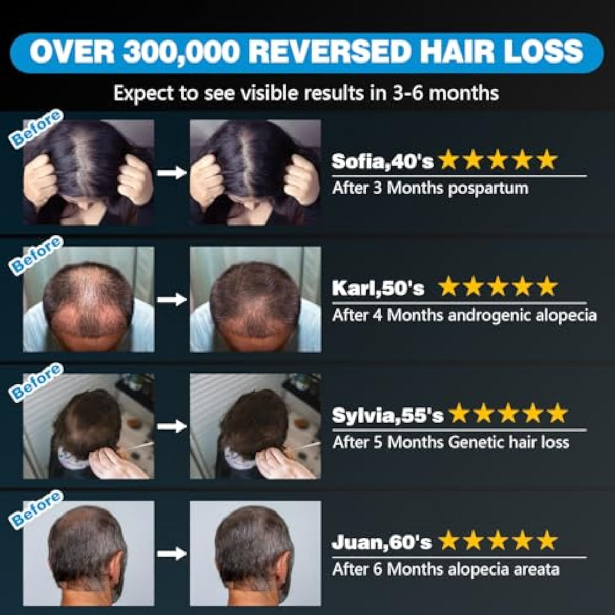 כובע לייזר מקצועי להצמחת שיער מחדש, מהדורת Pro 1.0 — LLLT באורך גל כפול